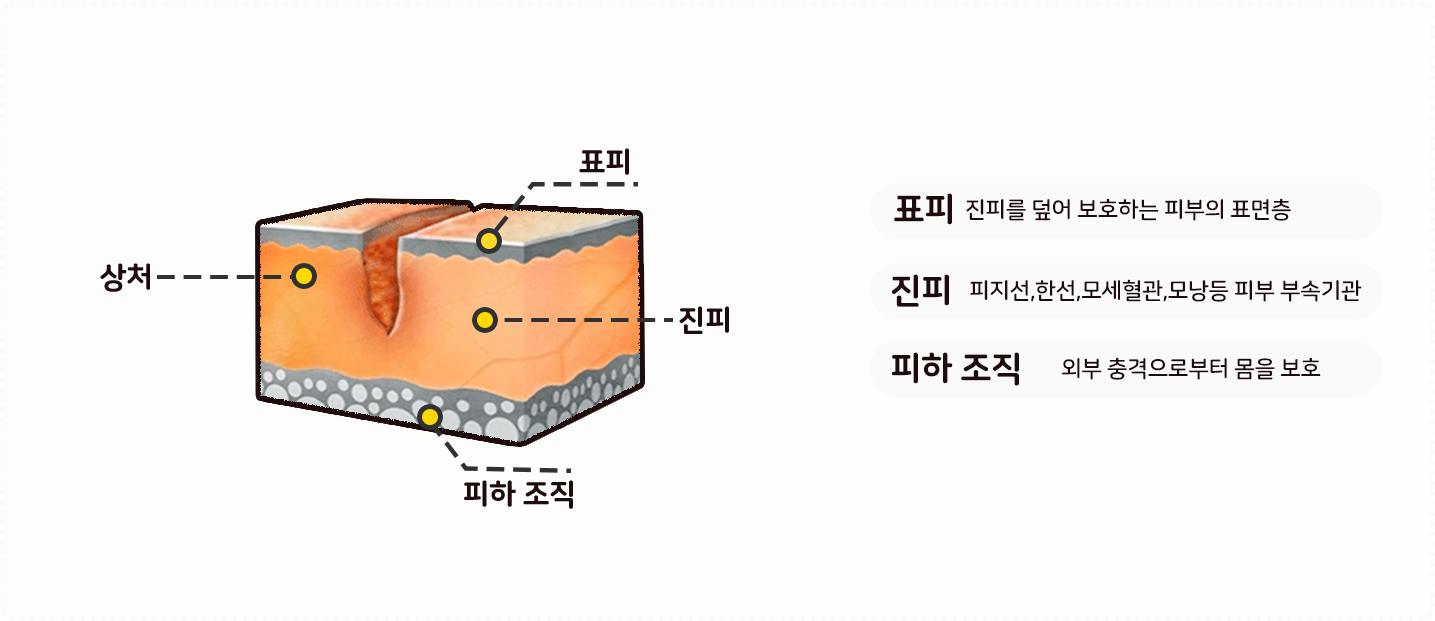 흉터 형성 과정